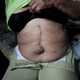 In a photo from 2010, Alba Cueran Pozos, then 65, shows the scars from cancerous tumors she had removed. She lived in the contaminated area of the rainforest for over 40 years.